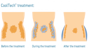 Crioterapia reductora