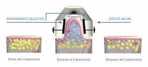 Crioterapia reductora
