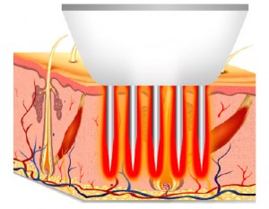radiofrecuencia fraccional
